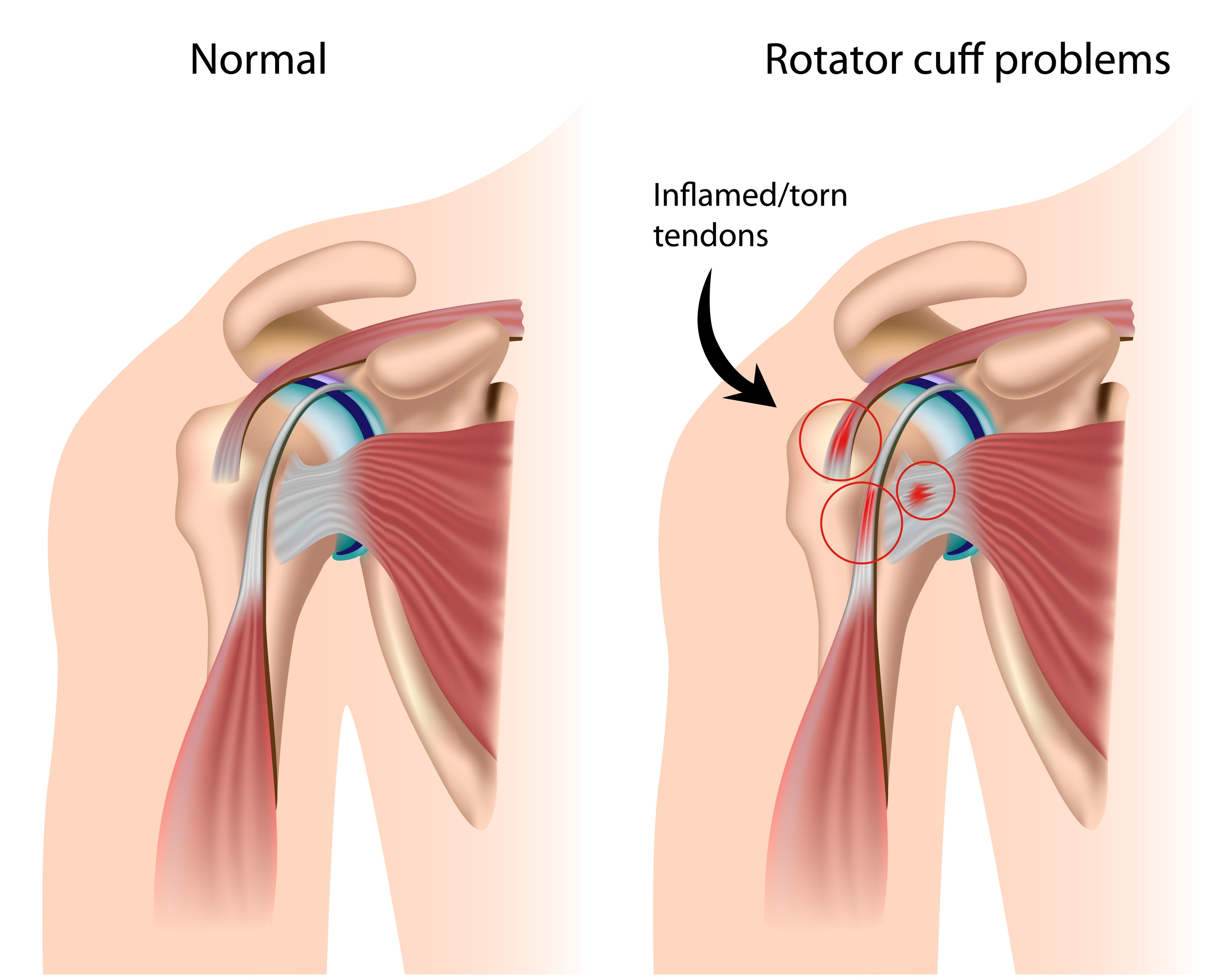 How Long To Heal A Torn Tendon